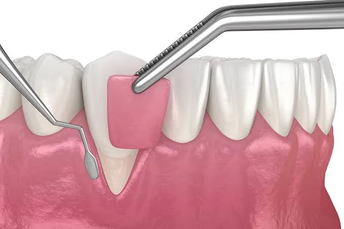 Gum Treatment